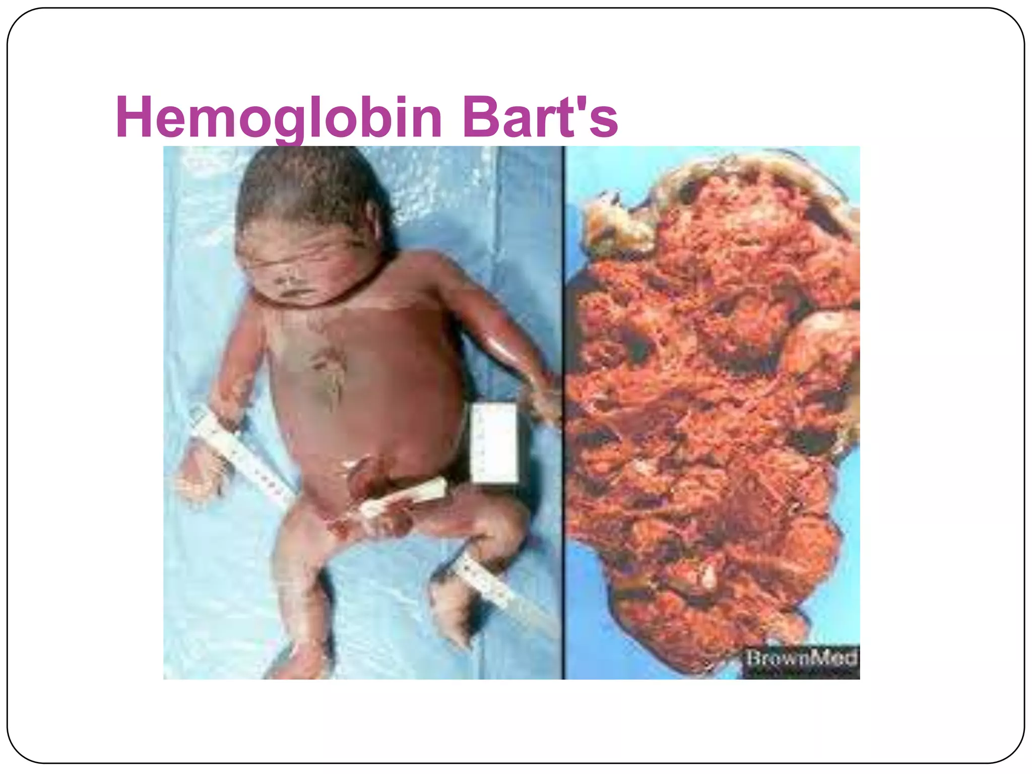 Hemoglobin Bart's
 