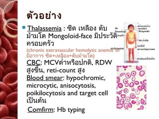 ตัว อย่า ง
Thalassemia: ซีด เหลือง ตับ
 ม้ามโต Mongoloid-face มีประวัติ
 ครอบครัว
 (chronic extravascular hemolytic anemia จะ
 มีอาการ ซีด+เหลือง+ตับม้ามโต)
 CBC: MCVตำ่าหรือปกติ, RDW
 สูงขึ้น, reti-count สูง
 Blood smear: hypochromic,
 microcytic, anisocytosis,
 poikilocytosis and target cell
 เป็นต้น
 Comfirm: Hb typing
 