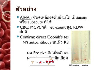 ตัว อย่า ง
AIHA   : ซีด+เหลือง+ตับม้ามโต เป็นacute
 หรือ subacute ก็ได้
CBC: MCVปกติ, reti-count สูง, RDW
 ปกติ
Confirm: direct Coomb’s test
  หา autoantibody บนผิว RBC

     ผล Positive คือเม็ดเลือดเกาะกลุ่ม
     ผล Negativeคือเม็ดเลือดไม่เกาะกัน
 
