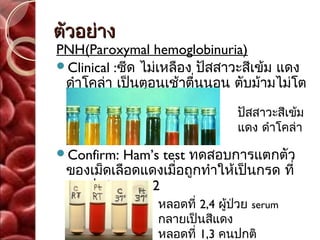 ตัวอย่าง
PNH(Paroxymal hemoglobinuria)
Clinical :ซีด ไม่เหลือง ปัสสาวะสีเข้ม แดง
 ดำาโคล่า เป็นตอนเช้าตื่นนอน ตับม้ามไม่โต

                                 ปัสสาวะสีเข้ม
                                 แดง ดำาโคล่า

Confirm: Ham’s test ทดสอบการแตกตัว
 ของเม็ดเลือดแดงเมื่อถูกทำาให้เป็นกรด ที่
 pH ประมาณ 6.2
                 หลอดที่ 2,4 ผู้ป่วย serum
                 กลายเป็นสีแดง
                 หลอดที่ 1,3 คนปกติ
 