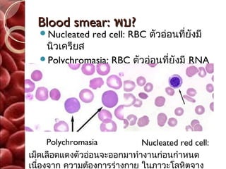 Blood smear: พบ?
  Nucleated    red cell: RBC ตัวอ่อนที่ยังมี
   นิวเครียส
  Polychromasia: RBC ตัวอ่อนที่ยังมี RNA
   ทำาให้ติดสีนำ้าเงินม่วง




     Polychromasia           Nucleated red cell:
เม็ดเลือดแดงตัวอ่อนจะออกมาทำางานก่อนกำาหนด
เนืองจาก ความต้องการร่างกาย ในภาวะโลหิตจาง
   ่
 