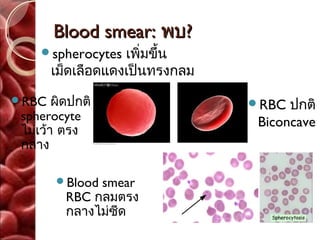 Blood smear: พบ?
     spherocytes  เพิ่มขึ้น
       เม็ดเลือดแดงเป็นทรงกลม
RBC    ผิดปกติ                 RBC  ปกติ
 spherocyte                      Biconcave
 ไม่เว้า ตรง
 กลาง

        Blood smear
          RBC กลมตรง
          กลางไม่ซีด
 