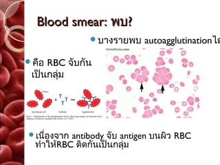 Blood smear: พบ?
               บางรายพบ     autoagglutinationได

คือ RBC จับกัน
 เป็นกลุ่ม




เนืองจาก
    ่      antibody จับ antigen บนผิว RBC
  ทำาให้RBC ติดกันเป็นกลุ่ม
 