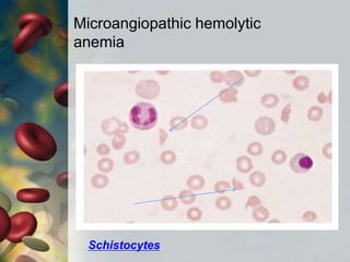 Microangiopathic hemolytic
anemia
Schistocytes
 
