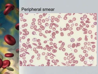 Peripheral smear
 