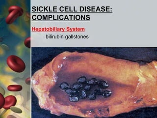 SICKLE CELL DISEASE:
COMPLICATIONS
Hepatobiliary System
bilirubin gallstones
 