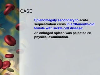 CASE
Splenomegaly secondary to acute
sequestration crisis in a 20-month-old
female with sickle cell disease:
An enlarged spleen was palpated on
physical examination.
 
