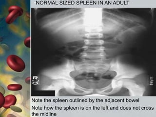 Note the spleen outlined by the adjacent bowel
Note how the spleen is on the left and does not cross
the midline
•NORMAL SIZED SPLEEN IN AN ADULT
 