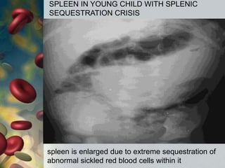 spleen is enlarged due to extreme sequestration of
abnormal sickled red blood cells within it
SPLEEN IN YOUNG CHILD WITH SPLENIC
SEQUESTRATION CRISIS
 