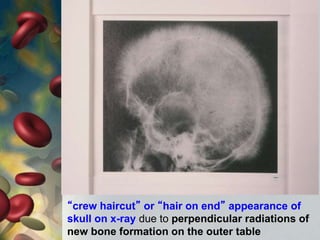 “crew haircut” or “hair on end” appearance of
skull on x-ray due to perpendicular radiations of
new bone formation on the outer table
 