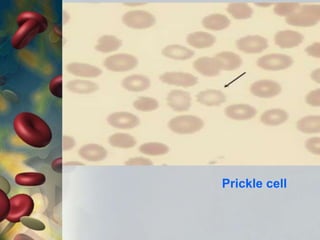 Prickle cell
 