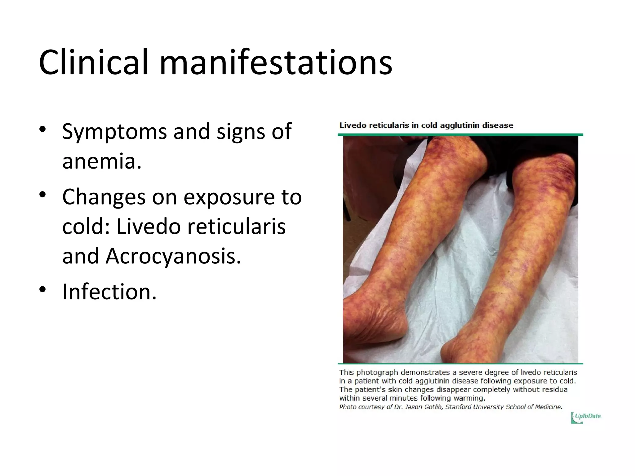 Clinical manifestations
• Symptoms and signs of
anemia.
• Changes on exposure to
cold: Livedo reticularis
and Acrocyanosis.
• Infection.