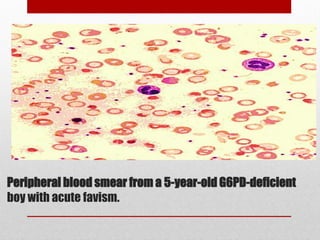Peripheral blood smear from a 5-year-old G6PD-deficient
boy with acute favism.
 