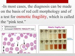 -In most cases, the diagnosis can be made
on the basis of red cell morphology and of
a test for osmotic fragility, which is called
the “pink test.”
.
 