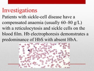 Investigations
Patients with sickle-cell disease have a
compensated anaemia (usually 60–80 g/L)
with a reticulocytosis and sickle cells on the
blood ﬁlm. Hb electrophoresis demonstrates a
predominance of HbS with absent HbA.
 