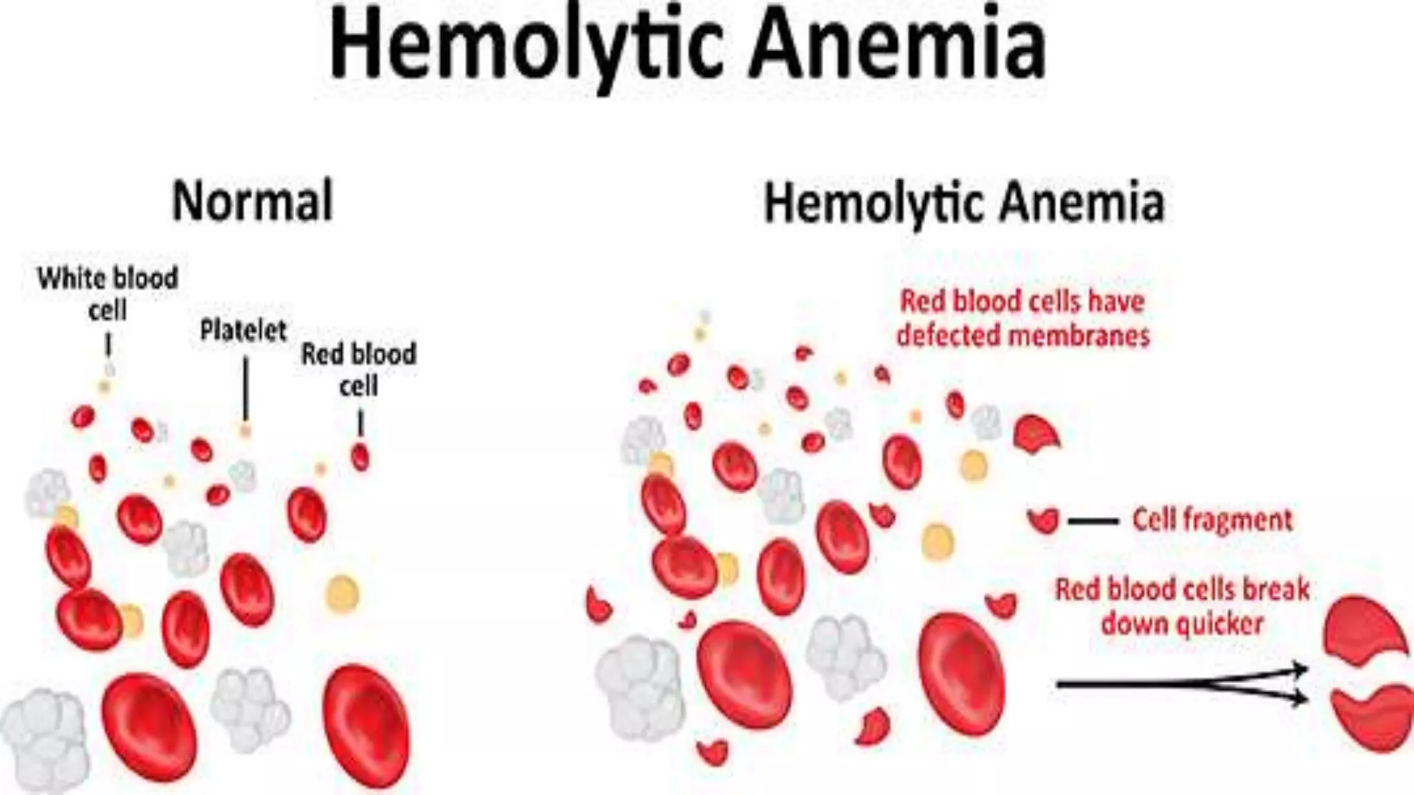 Hemolytic anemia | PPTX