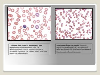 Peripheral blood film with Romanowsky stain
demonstrating polychromatophilic cells. The
polychromatophilic cells are basophilic because of
increased RNA content. The cells are usually larger than
normocytic red blood cells
Autoimmune hemolytic anemia. Numerous
spherocytes, small round RBCs lacking central
pallor, are shown in this blood smear from a case of
Coombs-positive hemolytic anemia.
 