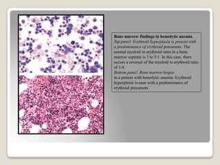 Bone marrow findings in hemolytic anemia.
Top panel: Erythroid hyperplasia is present with
a predominance of erythroid precursors. The
normal myeloid to erythroid ratio in a bone
marrow aspirate is 3 to 5:1. In this case, there
occurs a reversal of the myeloid to erythroid ratio
of 1:4.
Bottom panel: Bone marrow biopsy
in a patient with hemolytic anemia. Erythroid
hyperplasia is seen with a predominance of
erythroid precursors
 
