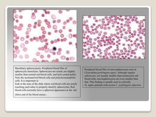 Hereditary spherocytosis. Peripheral blood film of
spherocytic hemolysis. Spherocytes are round, are slightly
smaller than normal red blood cells, and lack central pallor.
Note the nucleated red blood cells and polychromatophilic
cells. It is important to
look in the area of the slide where red blood cells are nearly
touching each other to properly identify spherocytes. Red
blood cells normally have a spherical appearance at the tail
(thin) end of the blood smear.
Peripheral blood film of microspherocytes seen in
Clostridium perfringens sepsis. Although regular
spherocytes are usually smaller than normocytic red
blood cells, microspherocytes are even smaller than
that. This finding is usually seen in critically
ill, septic patients with severe C. perfringens infection.
 