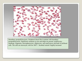 Hereditary pyropoikilocytosis. Peripheral blood film in patient with hereditary
pyropoikilocytosis. Significant variations in size and shape are present: poikliocytes,
teardrops, fragments, microspherocytes, elliptocytes, and small pieces and buds of redblood
cells. The cells are microcytic with low MCV . Incubted osmotic fragility increased
 