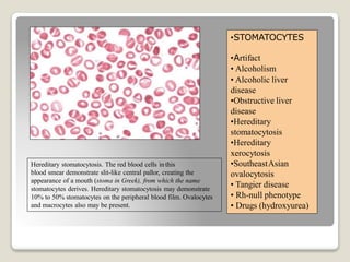 Hereditary stomatocytosis. The red blood cells inthis
blood smear demonstrate slit-like central pallor, creating the
appearance of a mouth (stoma in Greek), from which the name
stomatocytes derives. Hereditary stomatocytosis may demonstrate
10% to 50% stomatocytes on the peripheral blood film. Ovalocytes
and macrocytes also may be present.
•STOMATOCYTES
•Artifact
• Alcoholism
• Alcoholic liver
disease
•Obstructive liver
disease
•Hereditary
stomatocytosis
•Hereditary
xerocytosis
•SoutheastAsian
ovalocytosis
• Tangier disease
• Rh-null phenotype
• Drugs (hydroxyurea)
 