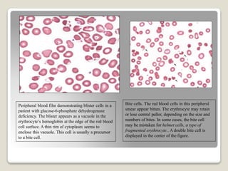 Peripheral blood film demonstrating blister cells in a
patient with glucose-6-phosphate dehydrogenase
deficiency. The blister appears as a vacuole in the
erythrocyte’s hemoglobin at the edge of the red blood
cell surface. A thin rim of cytoplasm seems to
enclose this vacuole. This cell is usually a precursor
to a bite cell.
Bite cells. The red blood cells in this peripheral
smear appear bitten. The erythrocyte may retain
or lose central pallor, depending on the size and
numbers of bites. In some cases, the bite cell
may be mistaken for helmet cells, a type of
fragmented erythrocyte.. A double bite cell is
displayed in the center of the figure.
 