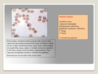 Heinz bodies. Peripheral blood stained with crystal violet
supravital stain demonstrating Heinz-body inclusions, which
are not visible with Romanowsky stains alone. Heinz bodies
are purple-blue, large, single or multiple inclusions attached
to the inner surface of the red blood cellmembrane. They
represent precipitated normal or unstable hemoglobins..
Reticulocytes do not stain with crystal violet.
•Heinz bodies
•Oxidative stress
glucose-6-phosphate
dehydrogenase deficiency,
glutathione synthetase deficiency
 Drugs
 Toxins
• Unstable hemoglobins
 