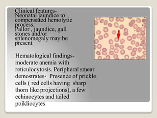 Clinical features-
Neonatal jaundice to
compensated hemolytic
process.
Pallor , jaundice, gall
stones and/or
splenomegaly may be
present
Hematological findings-
moderate anemia with
reticulocytosis. Peripheral smear
demostrates- Presence of prickle
cells ( red cells having sharp
thorn like projections), a few
echinocytes and tailed
poikliocytes
 