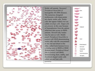 Sickle cell anemia. Top panel:
Peripheral blood film of
hemoglobin SS (HbS disease).
The numerous elongated
erythrocytes with sharp points
are classic sickle cells. Sickle
cells that appear folded over are
called envelope cells. Target cells
are present, in this case because
of hyposplenism from the splenic
infarction that occurs in HbSS
patients. Howell-Jolly bodies
may be seen as well. Middle
panel: Peripheral blood film in
patient with HbSS,demonstrating
sickle cells with Hb concentrated
at one end and absent at the
other, called hemi-lunes(arrows),
a finding seen in HbSS or HbSC.
Bottom panel: Peripheral blood
film in patient with HbSS,
demonstrating short, stubby, and
rhomboid-shaped sickle cells
called oat and boat cells
(arrows).
 