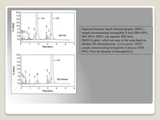 High-performance liquid chromatography (HPLC)
sample demonstrating hemoglobin S trait (HbA 60%,
HbS 40%). HPLC can separate HbS from
HbD/G/Lepore, which are seen in the same band on
alkaline Hb electrophoresis. Lower panel: HPLC
sample demonstrating hemoglobin S disease (HbS
90%). Note the absence of hemoglobinA.
 