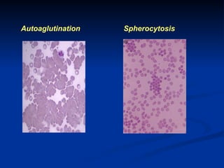 Autoaglutination Spherocytosis
 