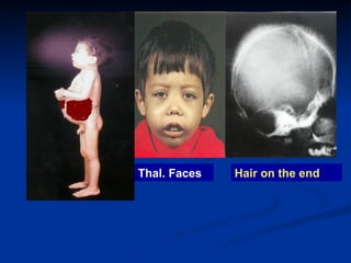 Hair on the end
Thal. Faces
 