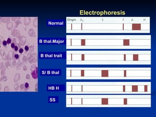 Electrophoresis
Normal
B thal.Major
B thal trait
S/ B thal
HB H
SS
 