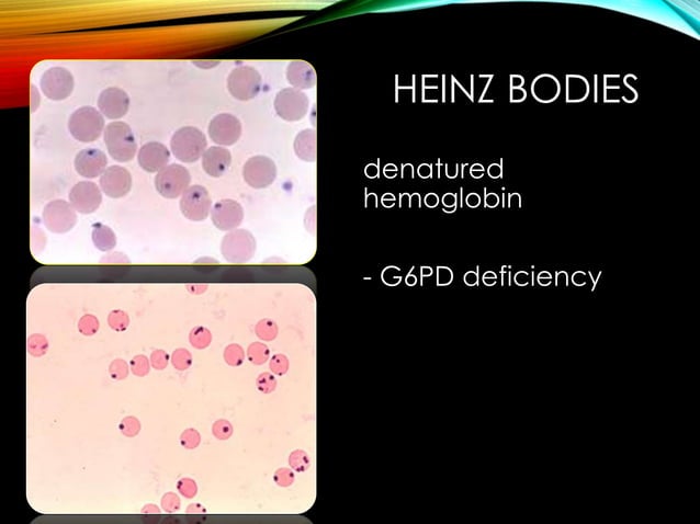 Hemolyticanemia afnan | PPT