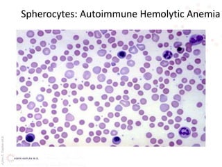 AşkınK.KaplanM.D.
Spherocytes: Autoimmune Hemolytic Anemia
 