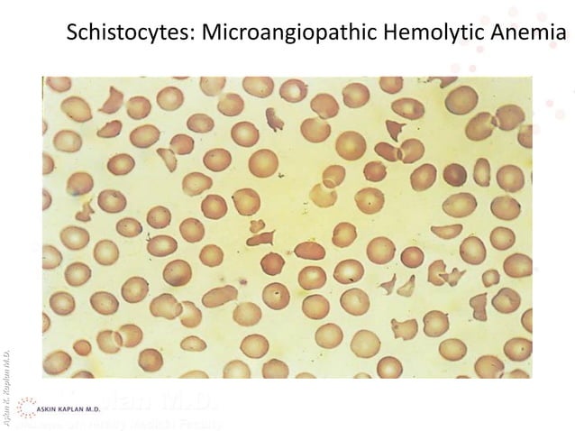Hemolytic anemia akk PPT Hemolytic anemia akk PPT