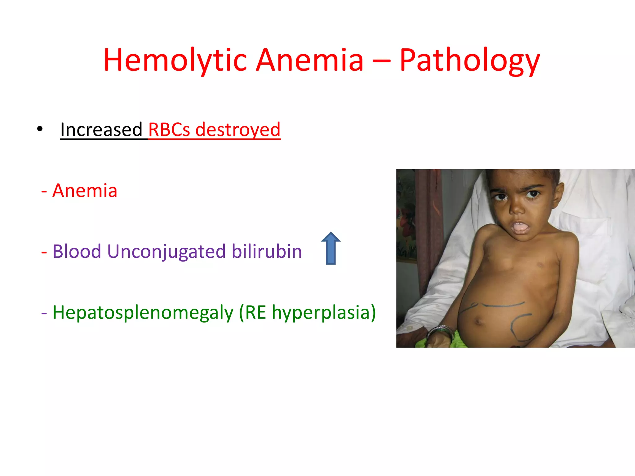 Hemolytic anemia in children 2021 | PDF