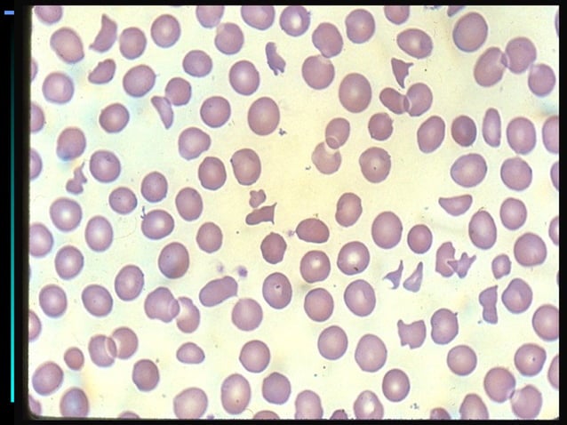 Hemolytic Anemia Ppt Presentation