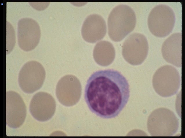 Hemolytic Anemia Ppt Presentation