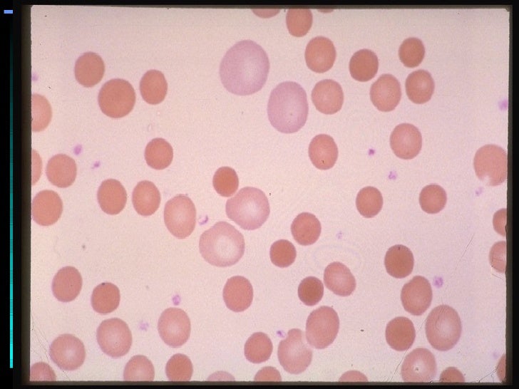 Hemolytic Anemia Ppt Presentation