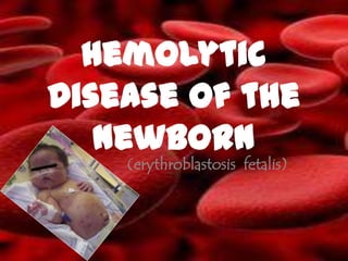 hemolytic
Disease of the
   Newborn
    (erythroblastosis fetalis)
 