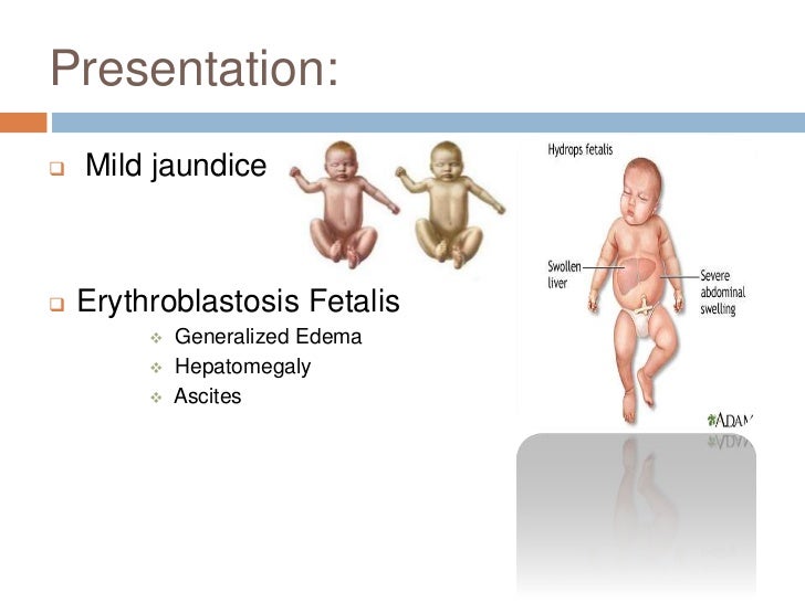 erythroblastosis fetalis
