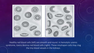 Healthy red blood cells (left) are smooth and round. In hemolytic uremic 
syndrome, toxins destroy red blood cells (right). These misshapen cells may clog 
the tiny blood vessels in the kidneys. 
 