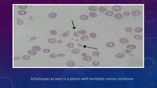 Schistocytes as seen in a person with hemolytic-uremic syndrome 
 