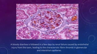 A bloody diarrhea is followed in a few days by renal failure caused by endothelial 
injury from the toxin, leading to the characteristic fibrin thrombi in glomerular 
and interstitial capillaries. 
 