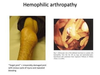 Hemophilic arthropathy
“Target joint” = irreversibly damaged joint
with vicious cycle of injury and repeated
bleeding
 