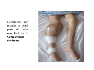 Hematomas into
muscles of distal
parts of limbs
may lead on to
Compartment
syndrome
 