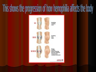 This shows the progression of how hemophilia affects the body  