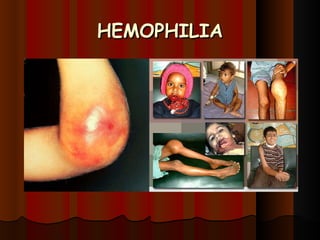 HEMOPHILIA 