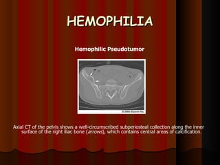 HEMOPHILIA Hemophilic Pseudotumor  Axial CT of the pelvis shows a well-circumscribed subperiosteal collection along the inner surface of the right iliac bone ( arrows ), which contains central areas of calcification. 